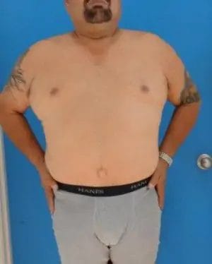 Body Lift Before & After Patient #12508