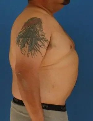 Body Lift Before & After Patient #12508