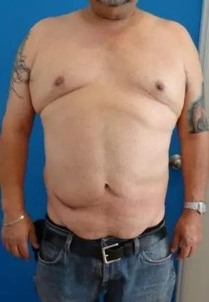 Body Lift Before & After Patient #12508
