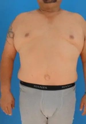 Body Lift Before & After Patient #12508