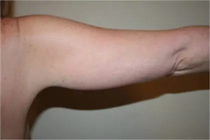 Liposuction Before & After Patient #12521