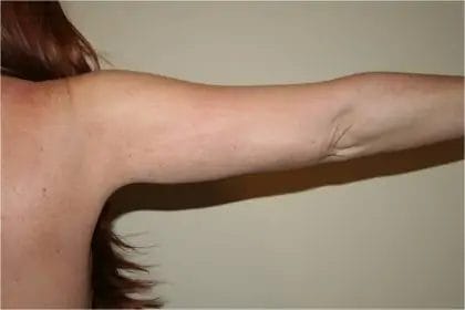 Liposuction Before & After Patient #12521