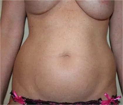 Liposuction Before & After Patient #12524