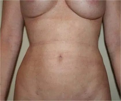 Liposuction Before & After Patient #12524