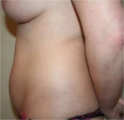 Liposuction Before & After Patient #12524