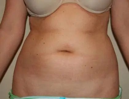 Liposuction Before & After Patient #12526