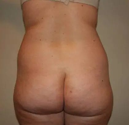 Liposuction Before & After Patient #12526
