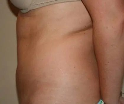 Liposuction Before & After Patient #12526