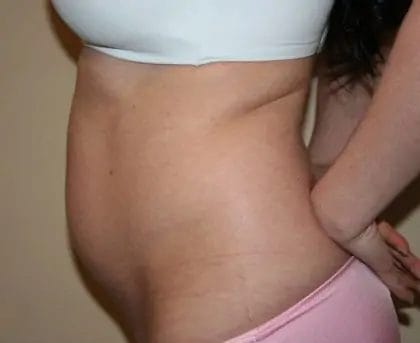 Liposuction Before & After Patient #12527