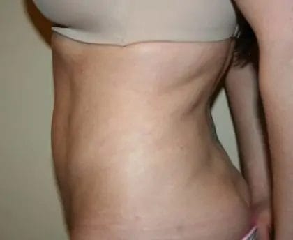 Liposuction Before & After Patient #12527