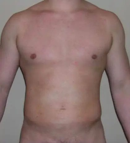 Liposuction Before & After Patient #12532