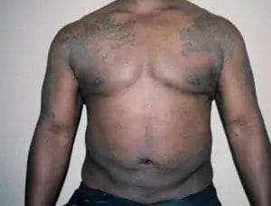 Liposuction Before & After Patient #12544