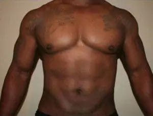 Liposuction Before & After Patient #12544