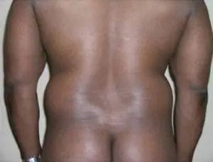 Liposuction Before & After Patient #12544