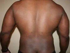 Liposuction Before & After Patient #12544