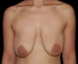 Breast Lift Before & After Patient #12560
