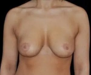 Breast Lift Before & After Patient #12560