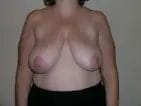 Breast Lift Before & After Patient #12562
