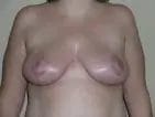 Breast Lift Before & After Patient #12562