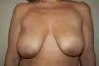 Breast Lift Before & After Patient #12566