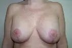 Breast Lift Before & After Patient #12566