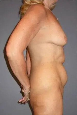 Body Lift Before & After Patient #13908