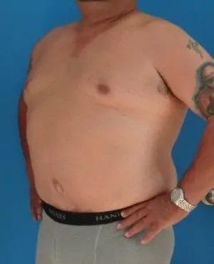 Body Lift Before & After Patient #13913