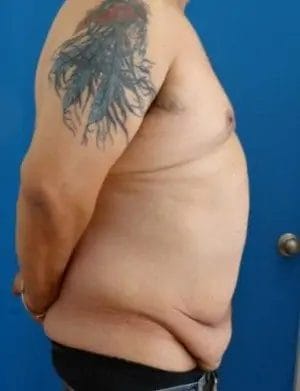 Body Lift Before & After Patient #13913