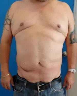 Body Lift Before & After Patient #13913