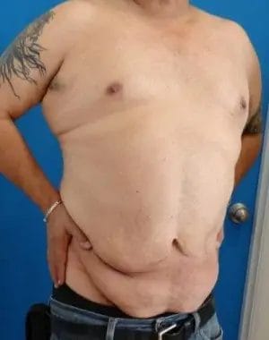 Body Lift Before & After Patient #13913