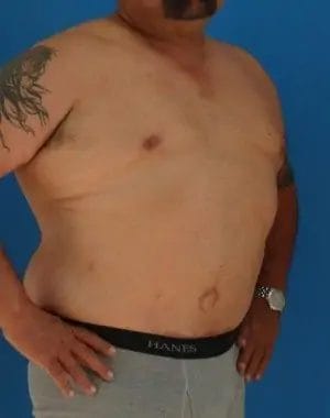 Body Lift Before & After Patient #13913