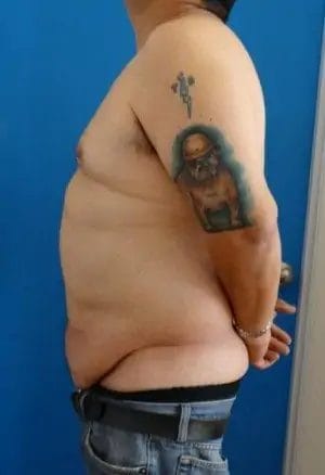 Body Lift Before & After Patient #13913