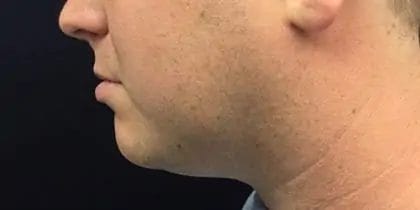 Liposuction Before & After Patient #13939