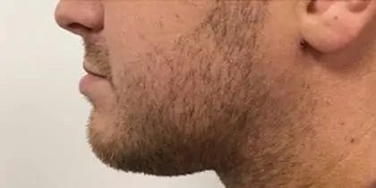 Liposuction Before & After Patient #13939