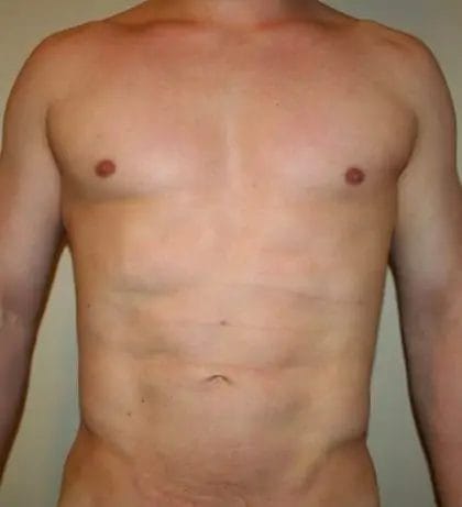Liposuction Before & After Patient #13945