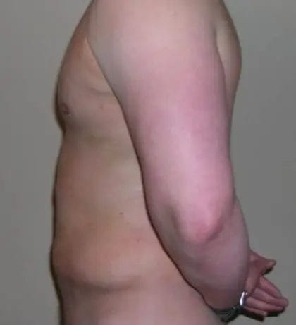 Liposuction Before & After Patient #13945