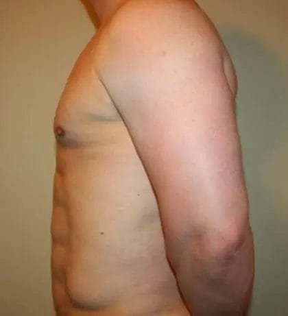 Liposuction Before & After Patient #13945