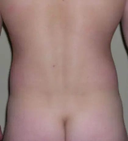 Liposuction Before & After Patient #13945