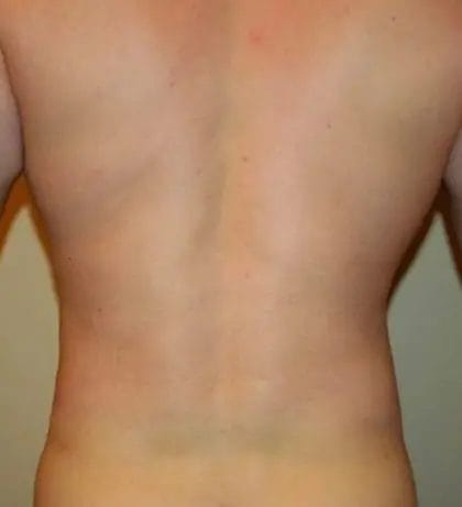 Liposuction Before & After Patient #13945