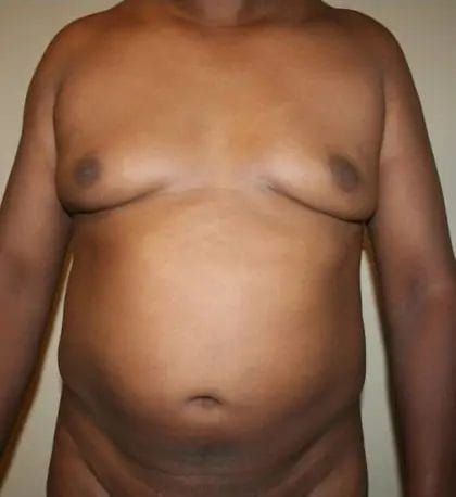 Liposuction Before & After Patient #13959