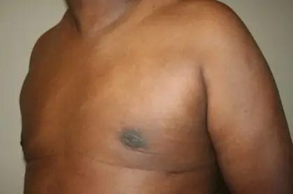 Liposuction Before & After Patient #13959