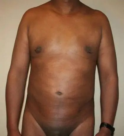 Liposuction Before & After Patient #13959