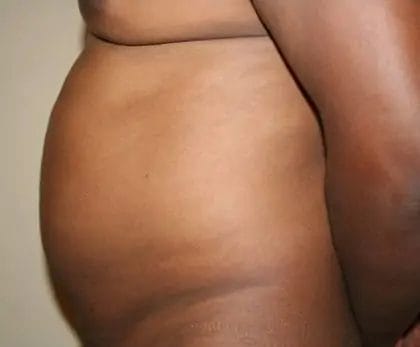 Liposuction Before & After Patient #13959