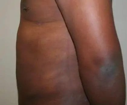 Liposuction Before & After Patient #13959