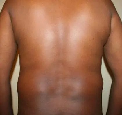 Liposuction Before & After Patient #13959