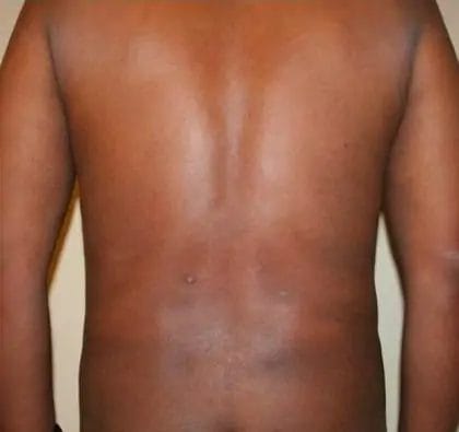 Liposuction Before & After Patient #13959