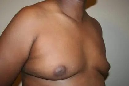 Liposuction Before & After Patient #13959