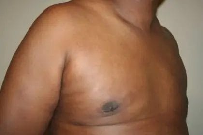 Liposuction Before & After Patient #13959