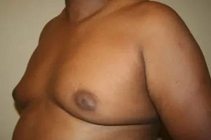 Liposuction Before & After Patient #13959