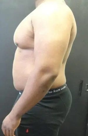 Liposuction Before & After Patient #13988